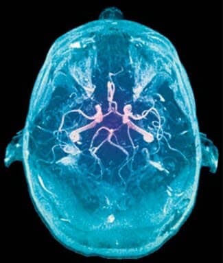 An angio-MRI of a 27-year-old woman reveals the arteries that provide oxygen to her brain.