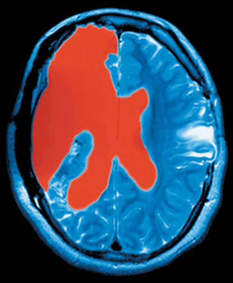 Cerebrospinal fluid (red) fills space in an MRI of a near-total hemispherectomy to ease seizures.